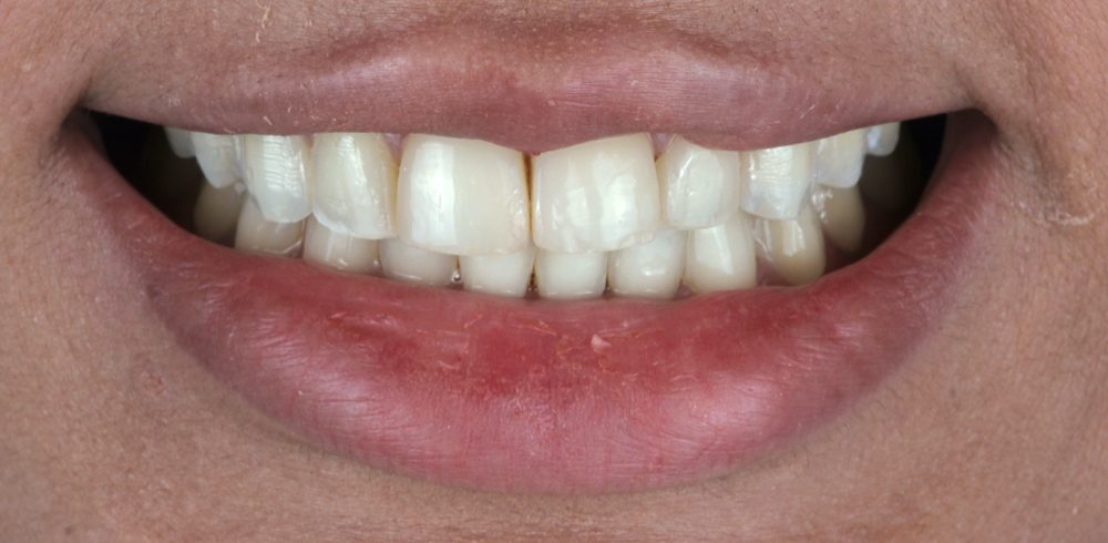 Before and after