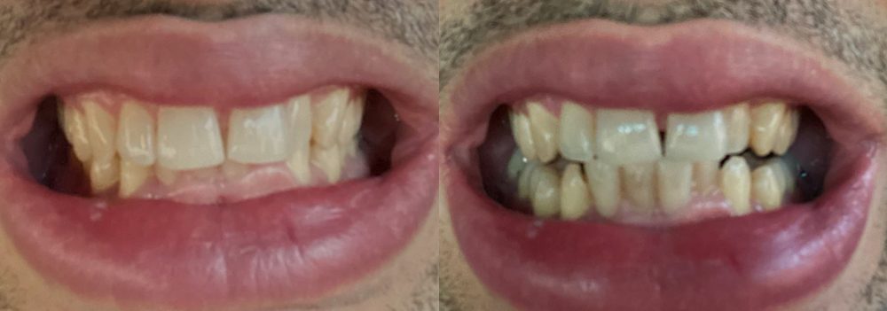 Before and after